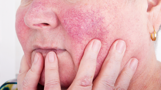 Blue light therapy for rosacea