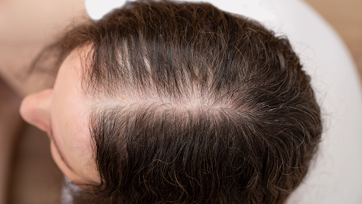 PRP therapy and robotic hair transplant options for hair loss treatment