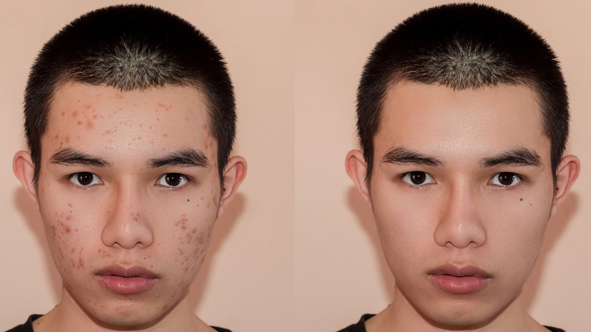 Gold Skin Care acne therapies